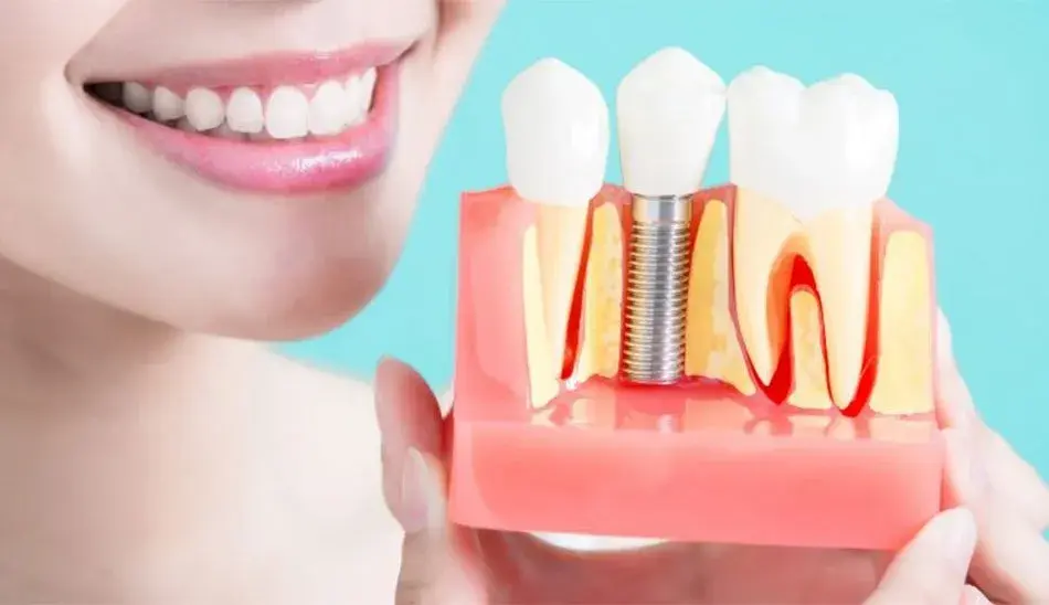 همه چیز درباره مراحل و عوارض ایمپلنت دندان