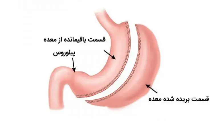 عمل اسلیو بهتر است یا بای پس؟ + مقایسه