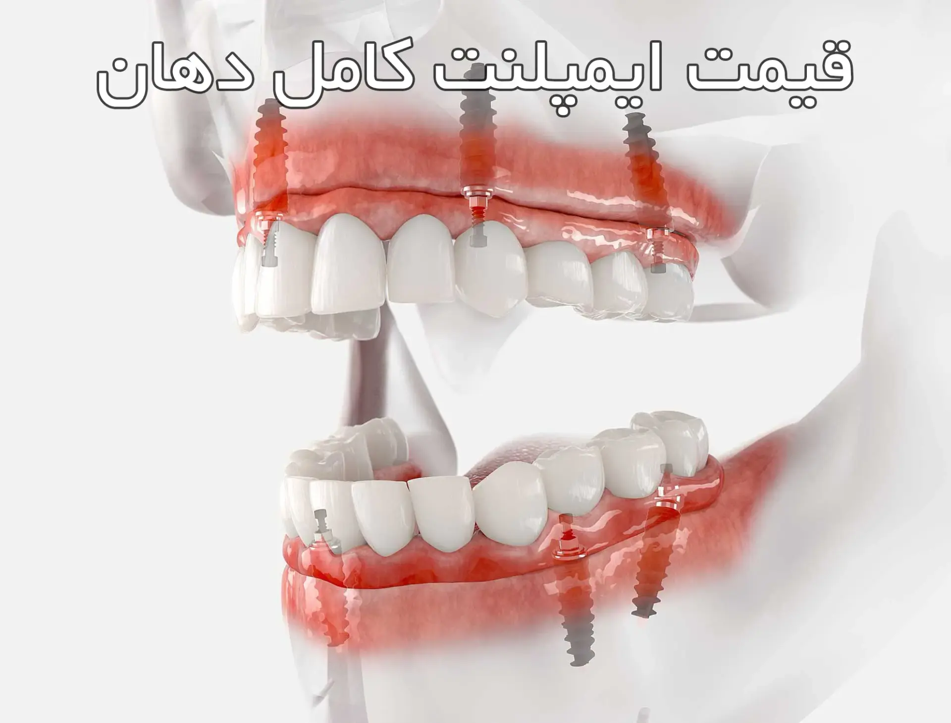 قیمت ایمپلنت کامل دهان ( 5 عامل موثر )