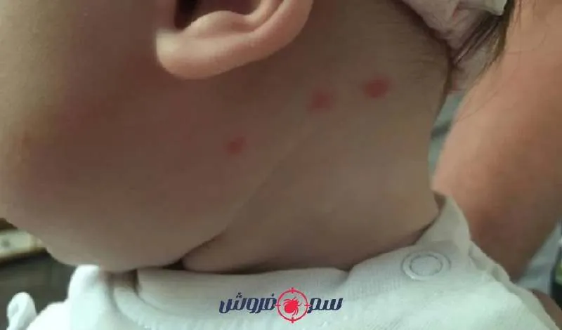 عکس جای نیش ساس