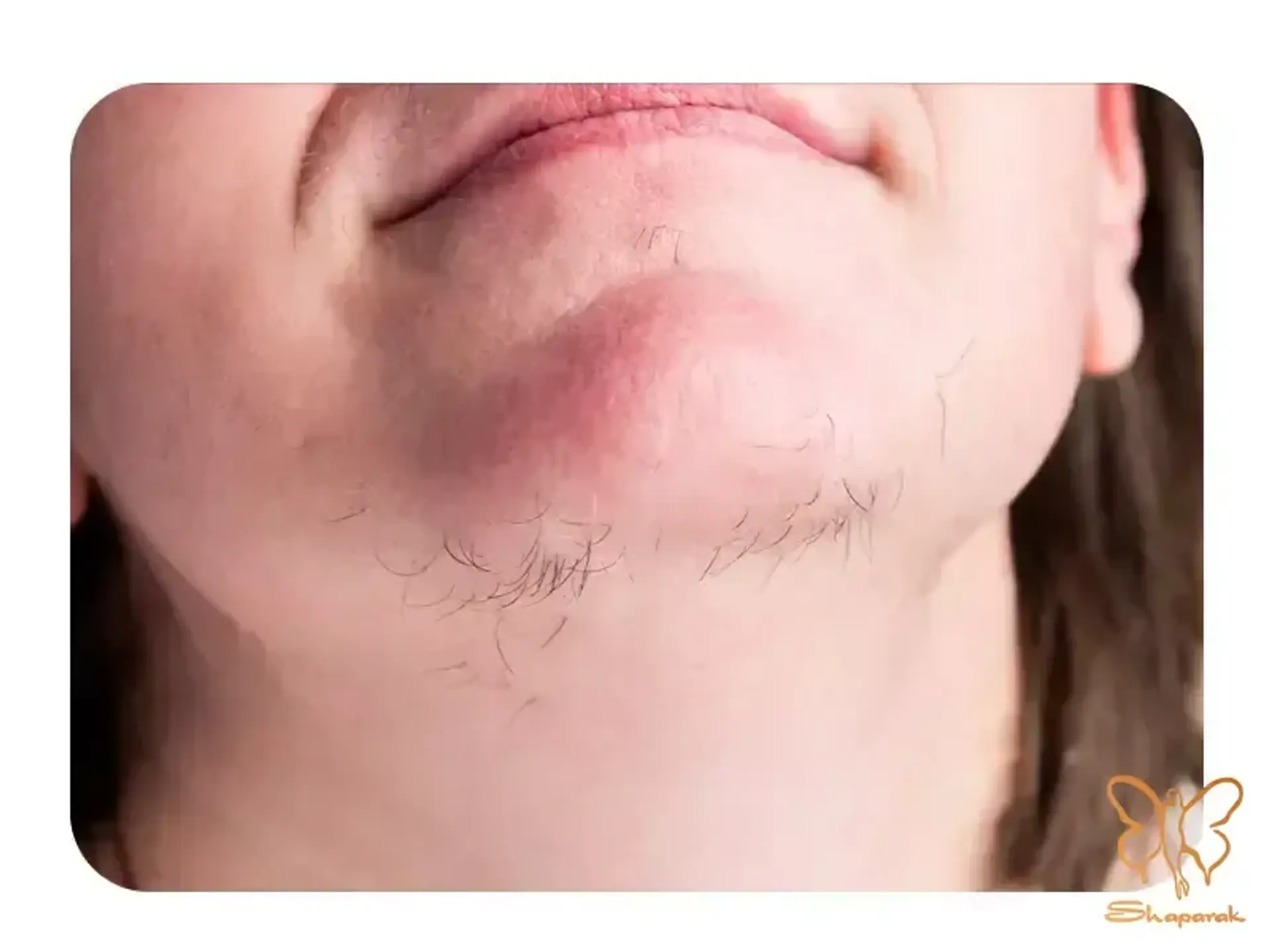 آیا با مصرف قرص‌های هورمونی باید با لیزر مو زائد خداحافظی کرد؟