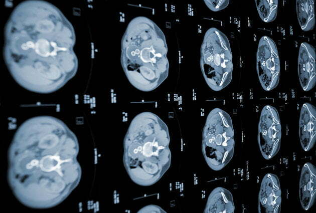 تشخیص سرطان به کمک هوش مصنوعی