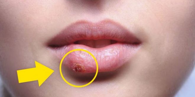 herpes virus causes Alzheimer's / ویروس تبخال عامل اصلی ابتلا به بیماری آلزایمر