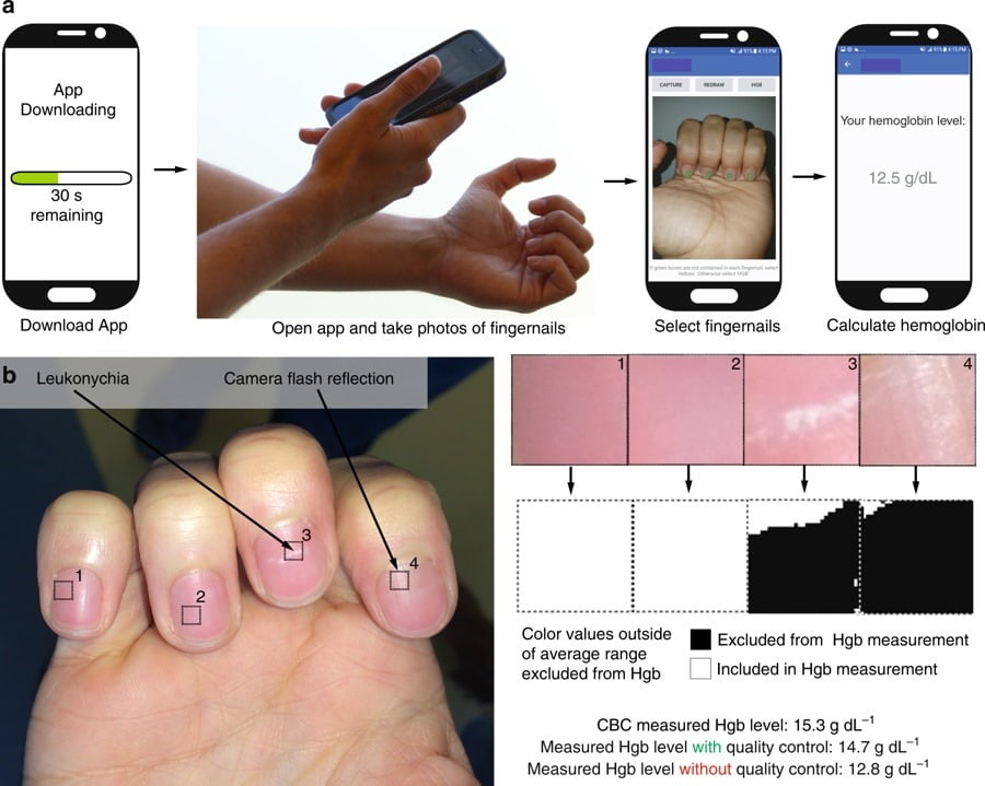 anemia test app / تشخیص کم خونی با اپلیکیشین