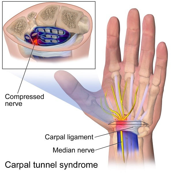 سندروم تونل کارپال / Carpal Tunnel Syndrome