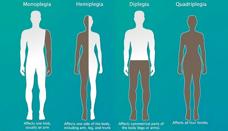 paralysis types / انواع فلج