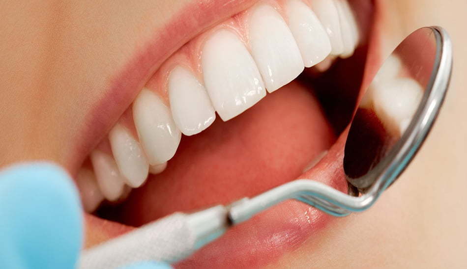 دندان عقل/wisdom tooth
