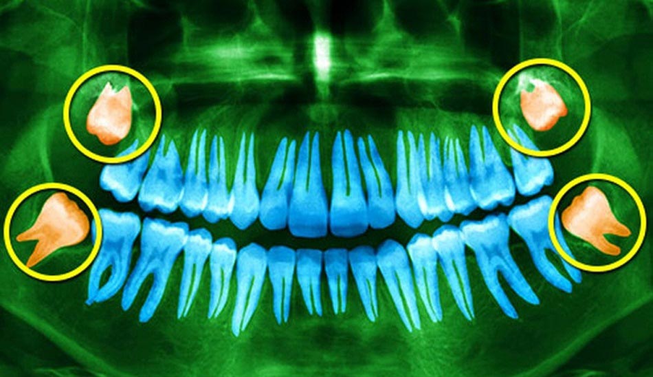 دندان عقل چیست / wisdom teeth