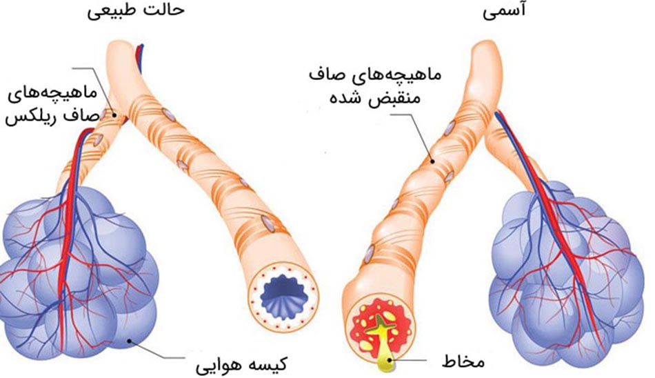 نشانه های بیماری آسم چیست