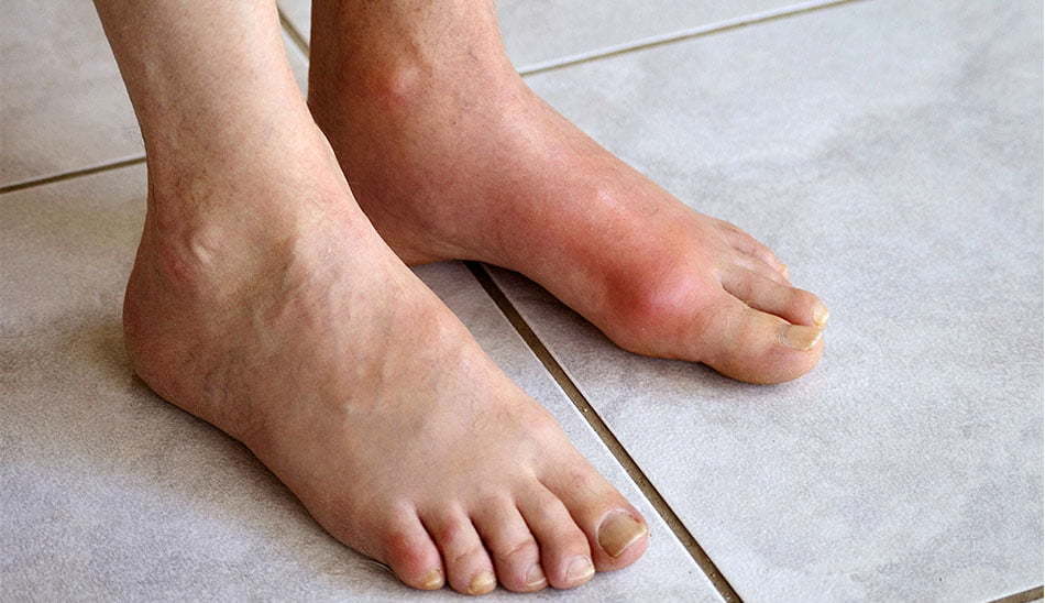 علل زانو درد