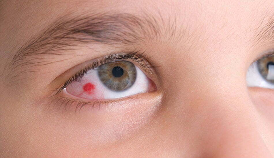 قرمزی چشم و سردرد نشانه چیست