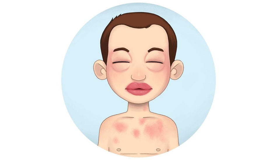از بین بردن ورم صورت / دلایل ورم صورت / دلیل ورم صورت