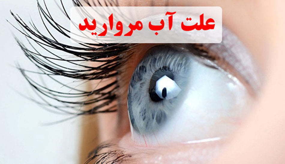 علت آب مروارید چشم