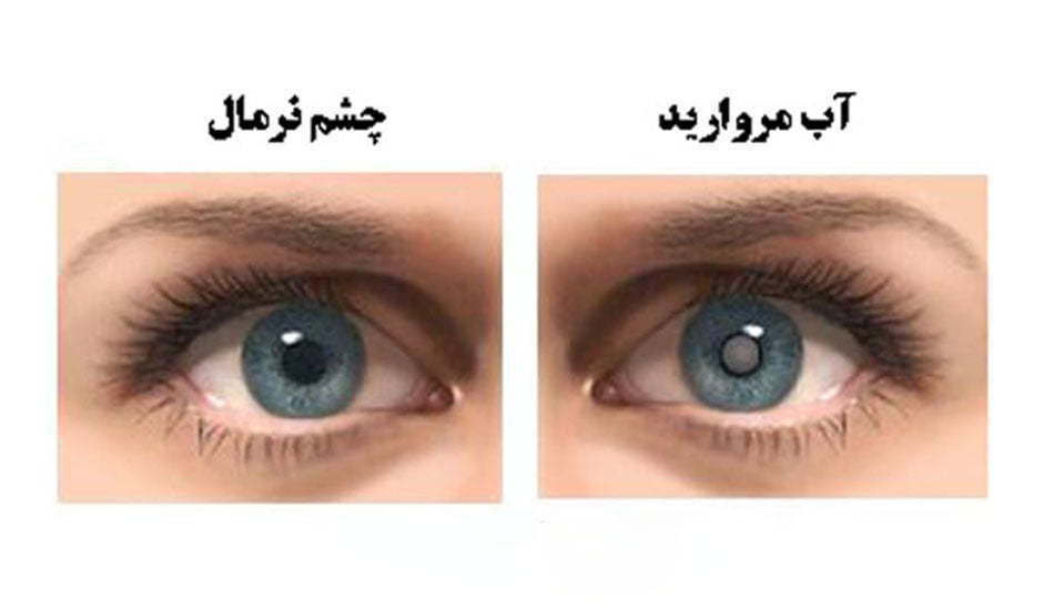 نشانه های آب مروارید چشم