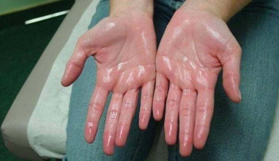 علت عرق كردن يک طرف بدن