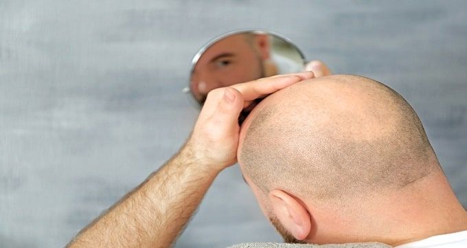 انواع روش های کاشت مو عبارتند از: