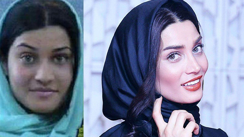 تصاویر قبل و بعد از عمل زیبایی بازیگران ایرانی