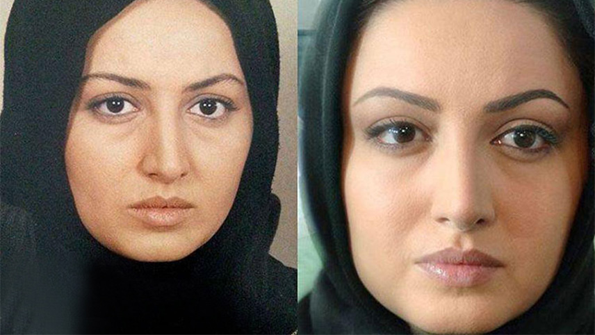 عکس بازیگران ایرانی قبل و بعد عمل زیبایی_شیلا خداداد