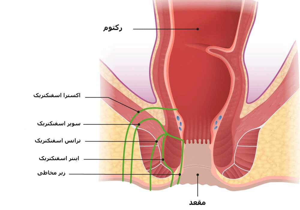 انواع بیماری فیستول