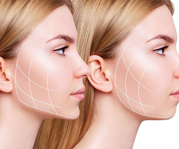 تزریق فیلر برای زاویه سازی فک چگونه انجام میشود؟