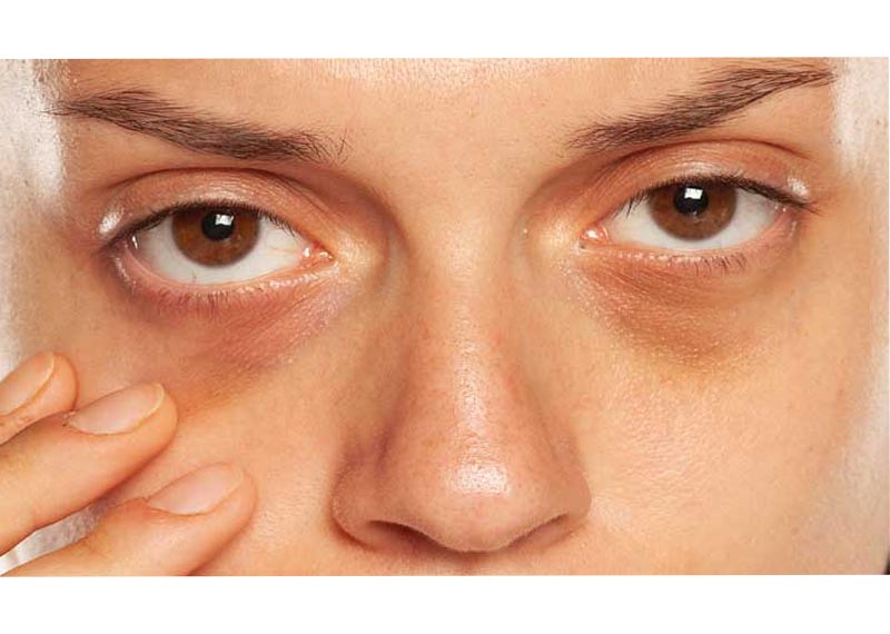 راهکارهایی برای مبارزه با تیرگی زیر چشم