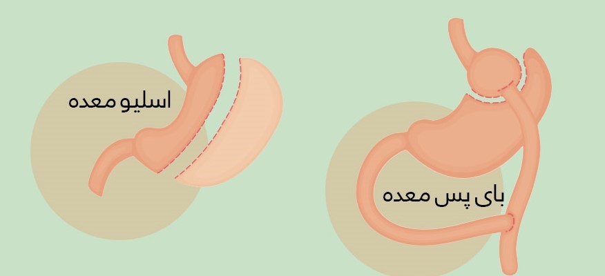 عمل اسلیو بهتر است یا بای پس؟ 